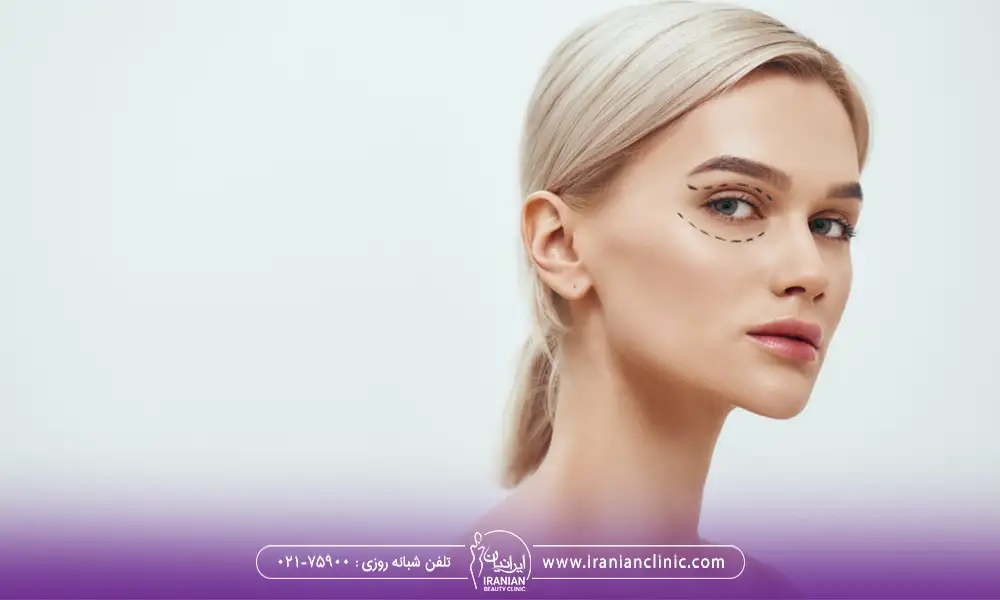 خانمی با موهای بلوند با نشانه گذاری روی چشم برای بلفاروپلاستی ترکیبی