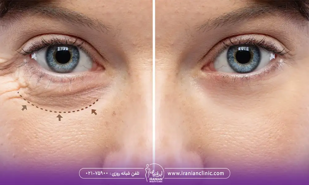 عکس قبل و بعد از بلفاروپلاستی آقا