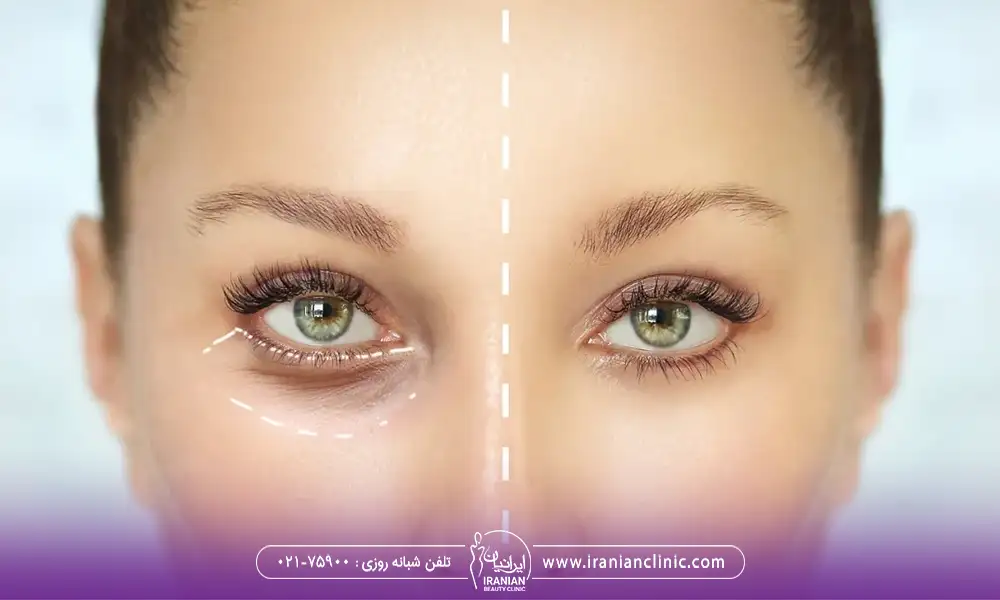 عکس قبل و بعد از بلفاروپلاستی خانم