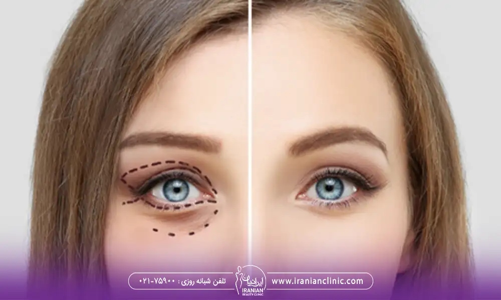 عکس قبل و بعد بلفاروپلاستی پلک بالا و پایین یک خانم چشم رنگی | هزینه بلفاروپلاستی