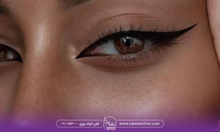 چشمان گربه ای بعد از عمل بلفاروپلاستی چشم گربه ای