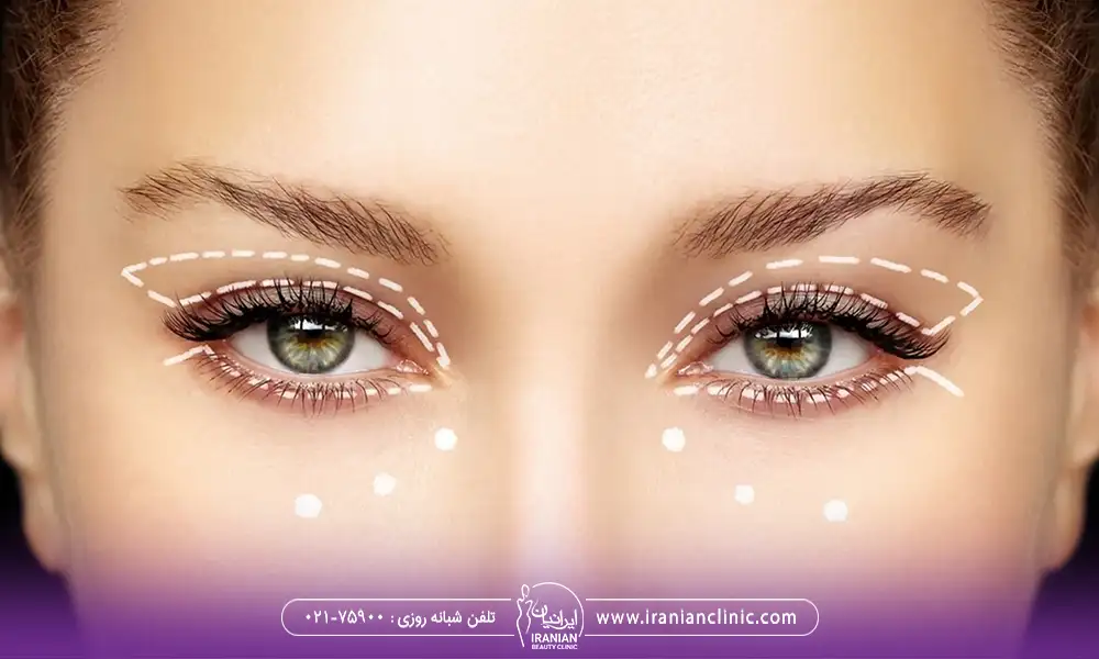 نحوه انجام بلفاروپلاستی چشم گربه ای
