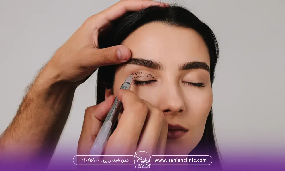 مشخص کردن ناحیه انجام جراحی پلک برای یک خانم توسط پزشک | هزینه بلفاروپلاستی