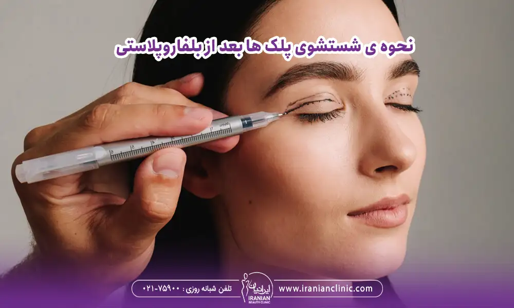 علامت گذاشتن پلک بالا برای جراحی | مراقبت بعد از بلفاروپلاستی