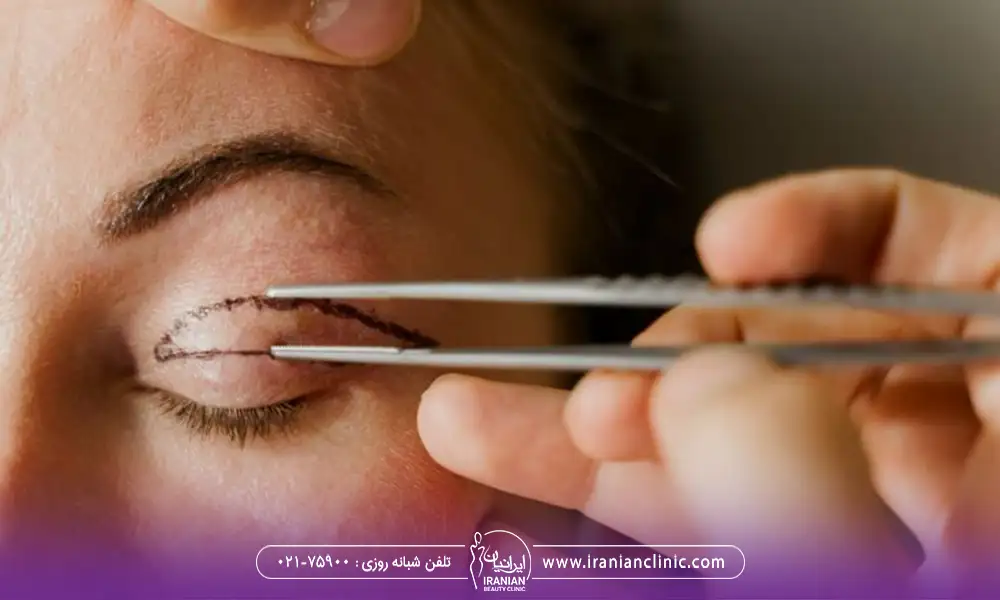 مشخص کردن قسمتی از پلک برای جراحی پلک در بهترین کاندیدای بلفاروپلاستی
