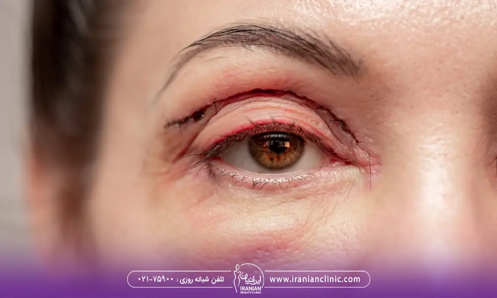 جراحی انجام شده روی پلک بالا یک خانم | هزینه بلفاروپلاستی