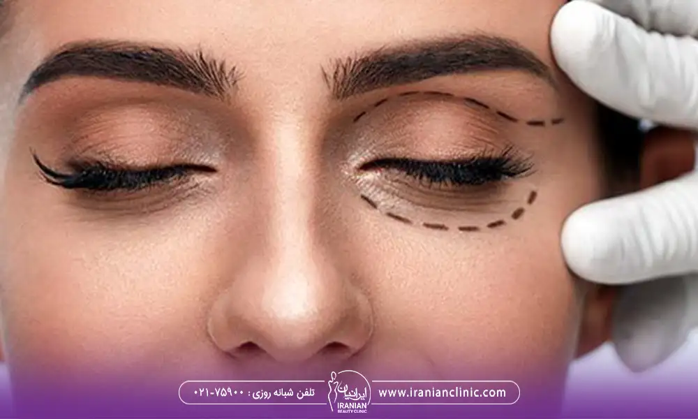 ماژیک کشیدن دور چشم یک خانم برای بهترین کاندیدای بلفاروپلاستی