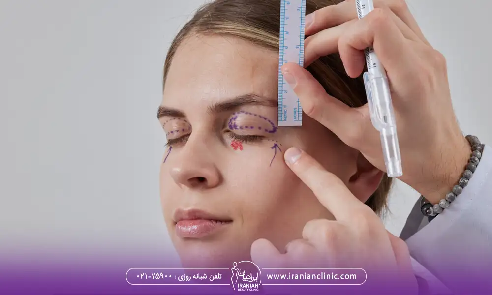 کشخص کردن نقطه بلفارو پلاستی | عوارض بلفاروپلاستی