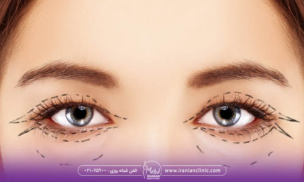 مشخص کردن ناحیه های جراحی پلک بر بروی هر دو چشم یک خانم | عوارض بلفاروپلاستی