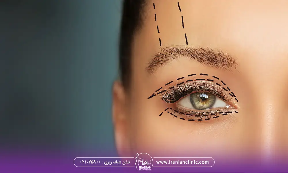 مناطقی که برای جراحی پلک مشخص شده است | ماندگاری بلفاروپلاستی