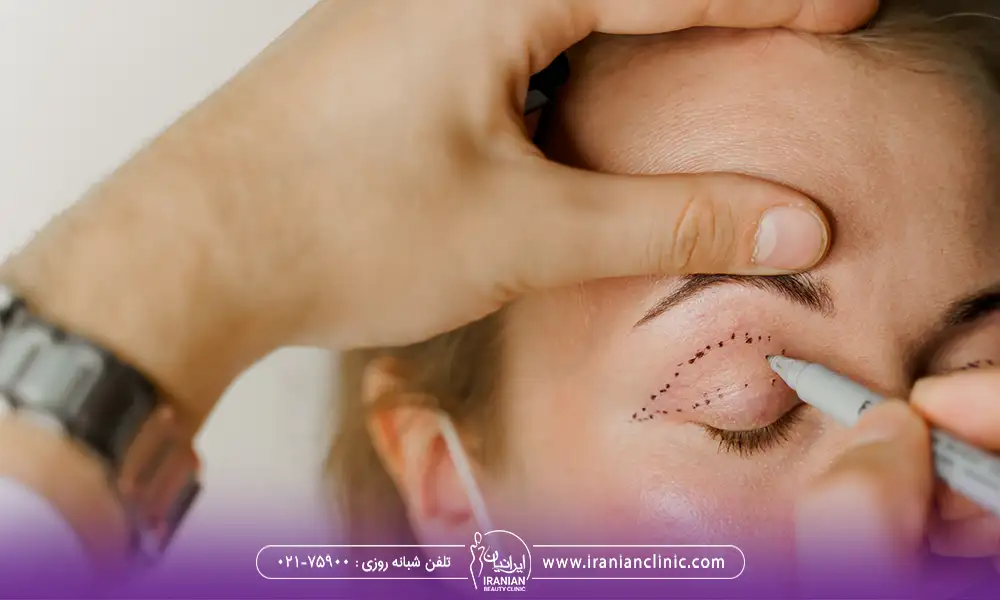 به نمایش گزاری قسمتی از پلک بالا برای بلفاروپلاستی | کوچک شدن چشم بعد از عمل بلفاروپلاستی