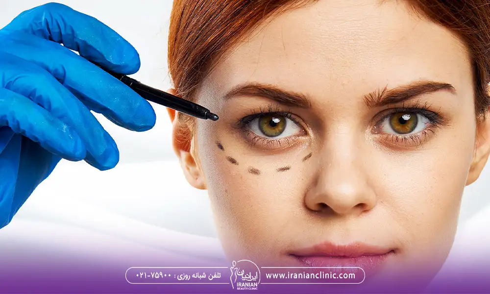 کلینیک بلفاروپلاستی در تهران در حال آماده کردن خانم برای عمل زیبایی پلک