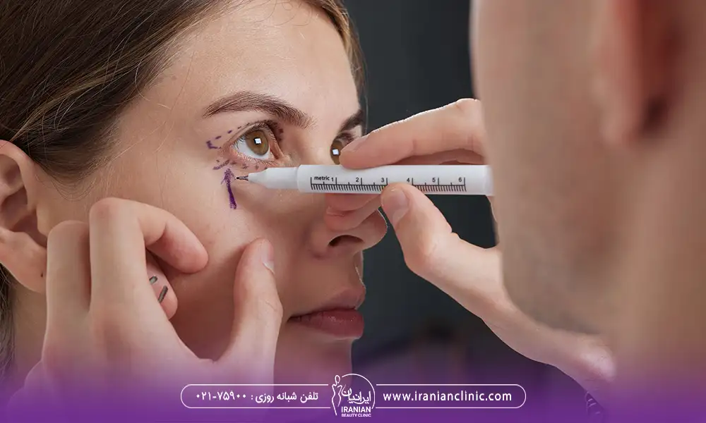 پزشک ئر حال علامت زدن پلک بالا و پایین برای عمل جراحی پلک | ماندگاری بلفاروپلاستی