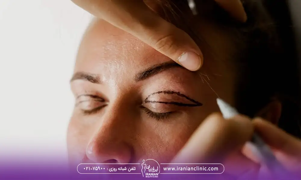 نشانه گزاری پلک بالا برای جراحی | کوچک شدن چشم بعد از عمل بلفاروپلاستی