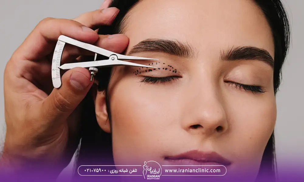 علامتگذاری دقیق پلک راست یک خانم برای جراحی پلک | بهترین سن برای عمل بلفاروپلاستی