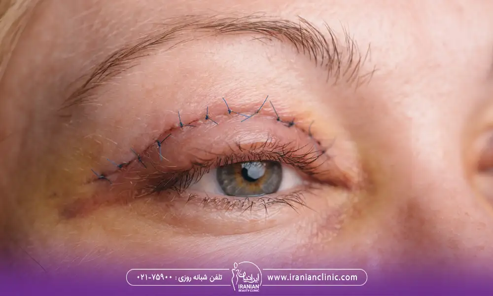 بخیه های بعد از جراحی پلک بالا | گوشت اضافه بعد از عمل بلفاروپلاستی