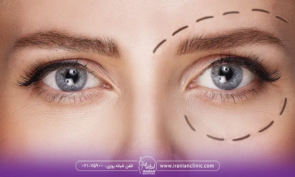 مشخص کردن منطقه عمل پلک | عوارض بلفاروپلاستی