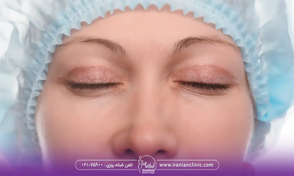 عکس بعد از جراحی پلک های خانم | کوچک شدن چشم بعد از عمل بلفاروپلاستی