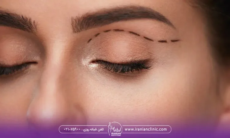 علامتگذاری پلک بالای خانم برای جراحی در کلینیک بلفاروپلاستی در تهران