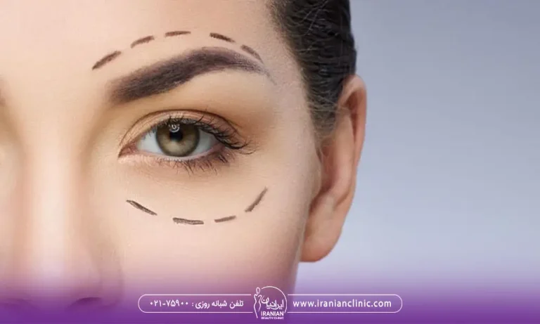 علامتگذاری پلک بالا و پایین برای جراحی پلک | عوارض بلفاروپلاستی