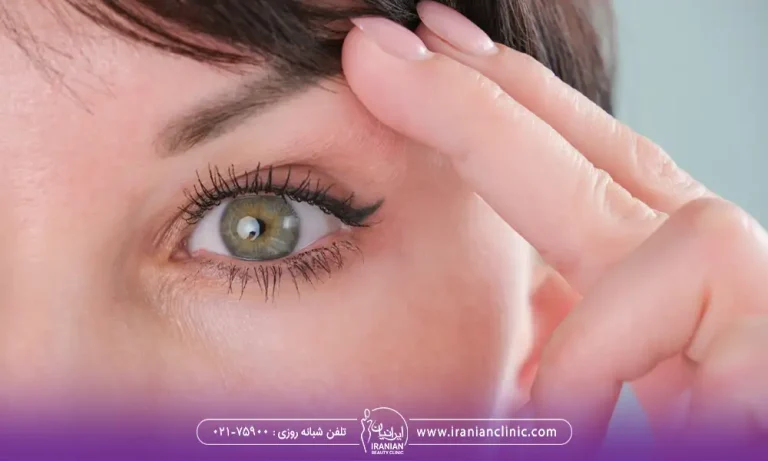 بالا کشیدن پلک با انگشت توسط خانمی با چشم های سبز رنگی | گوشت اضافه بعد از عمل بلفاروپلاستی