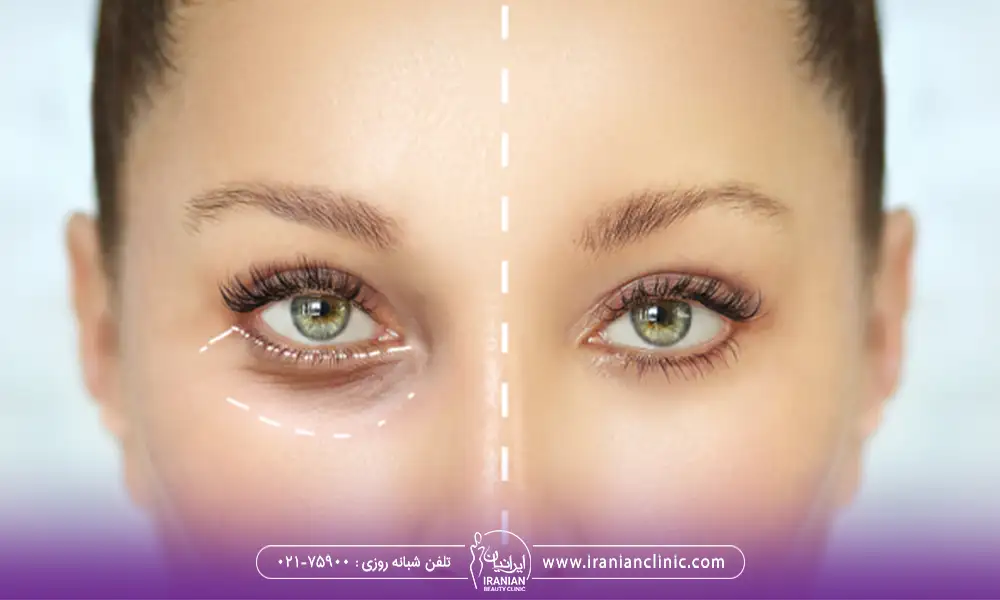 عمل پلک پایین بدون بخیه با عکس قبل و بعد