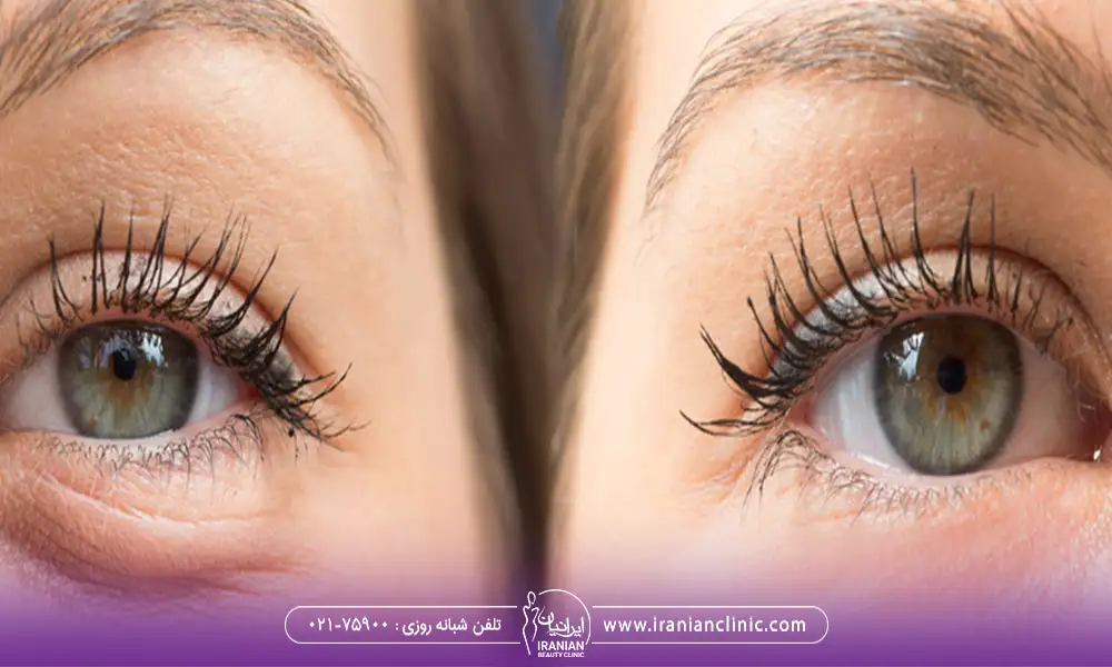 عکس قبل و بعد عمل پلک پایین بدون بخیه