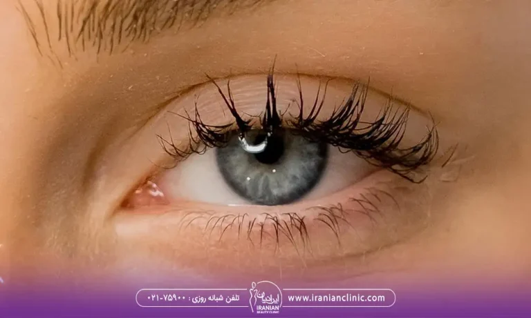 کانتوپلاستی