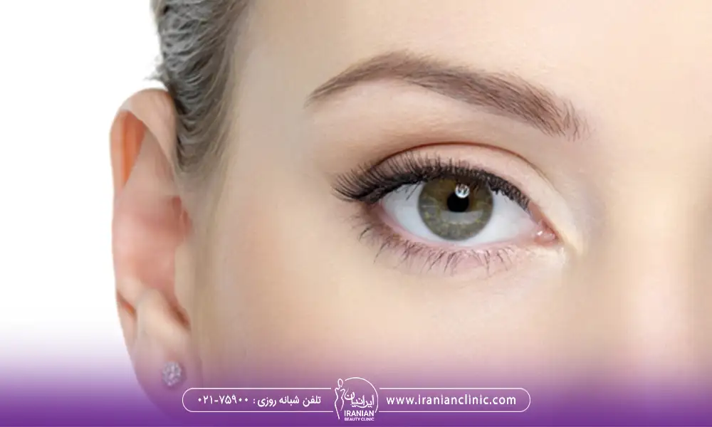 کانتوپلاستی برای یک چشم