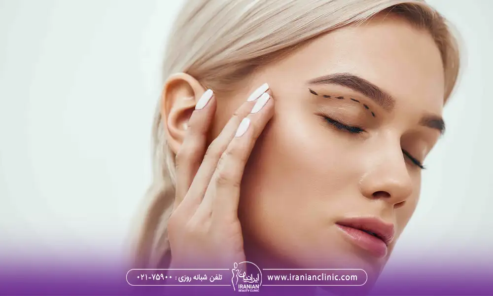مشخص کردن پلک بالا برای جراحی زیبایی پلک