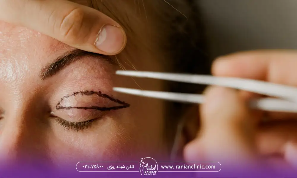 جراحی زیبایی پلک برای یک خانم