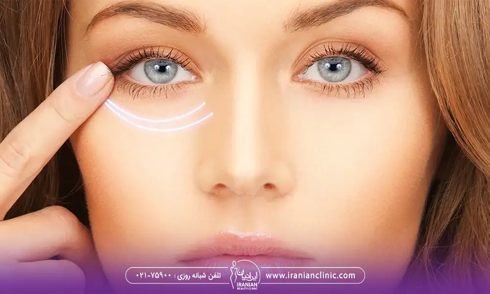 نمایش پلک پایین برای جراحی زیبایی پلک
