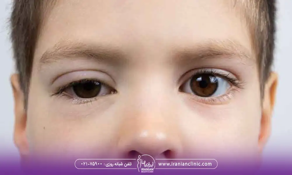 کودک دارای افتادگی پلک مادرزادی