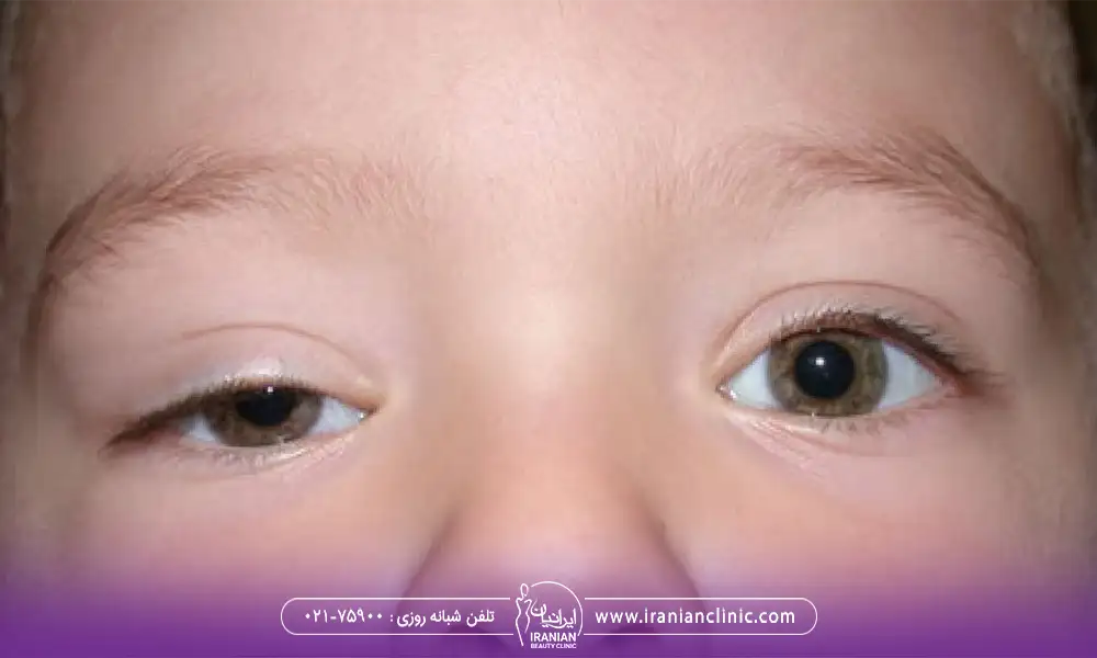 کودکی با افتادگی پلک مادرزادی