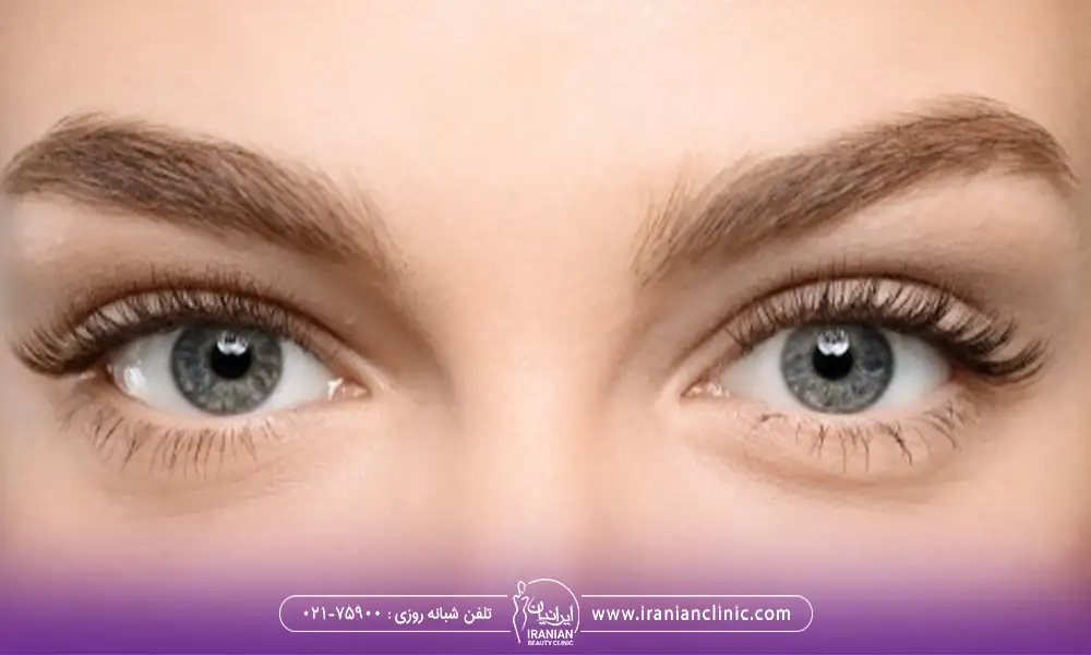 کانتوپلاستی برای هر دو چشم