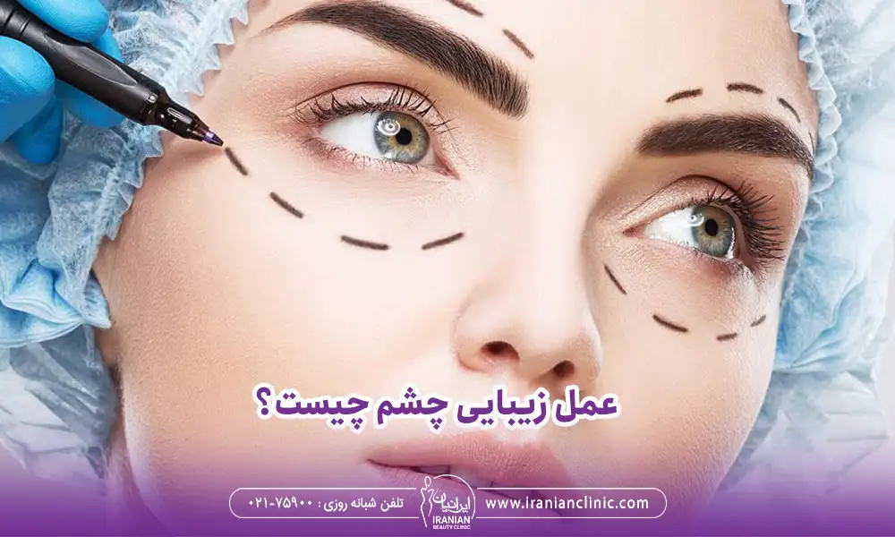 عمل زیبایی چشم برای هر دو چشم خانمی با چشمان جذاب