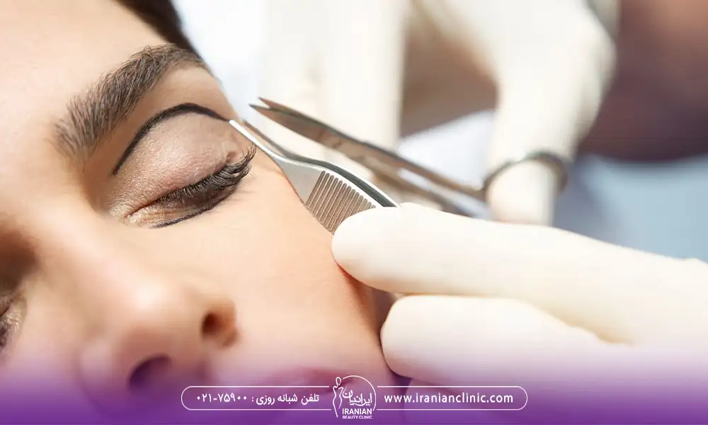 توضیح نحوه انجام جراحی پلک