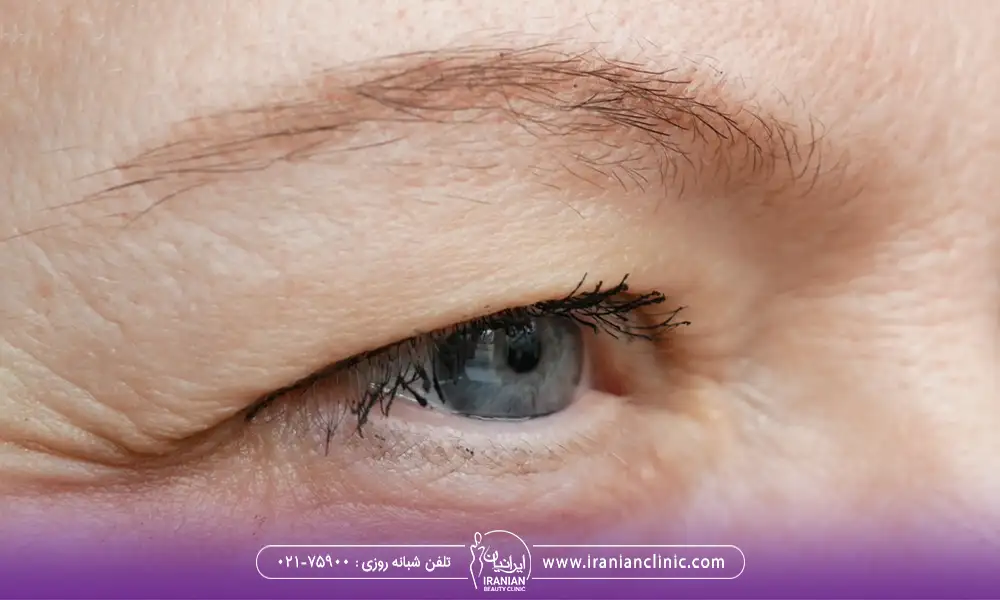 خانمی با چشمان رنگی در انتظار جراحی رفع افتادگی پلک
