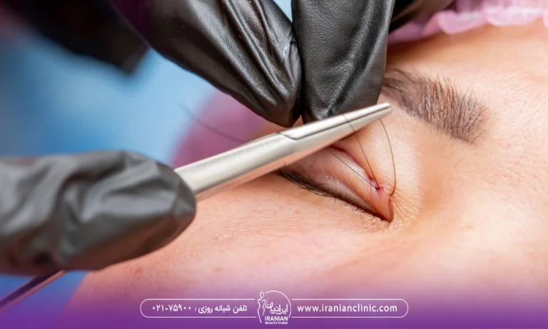 بخیه زدن بعد جراحی پلک