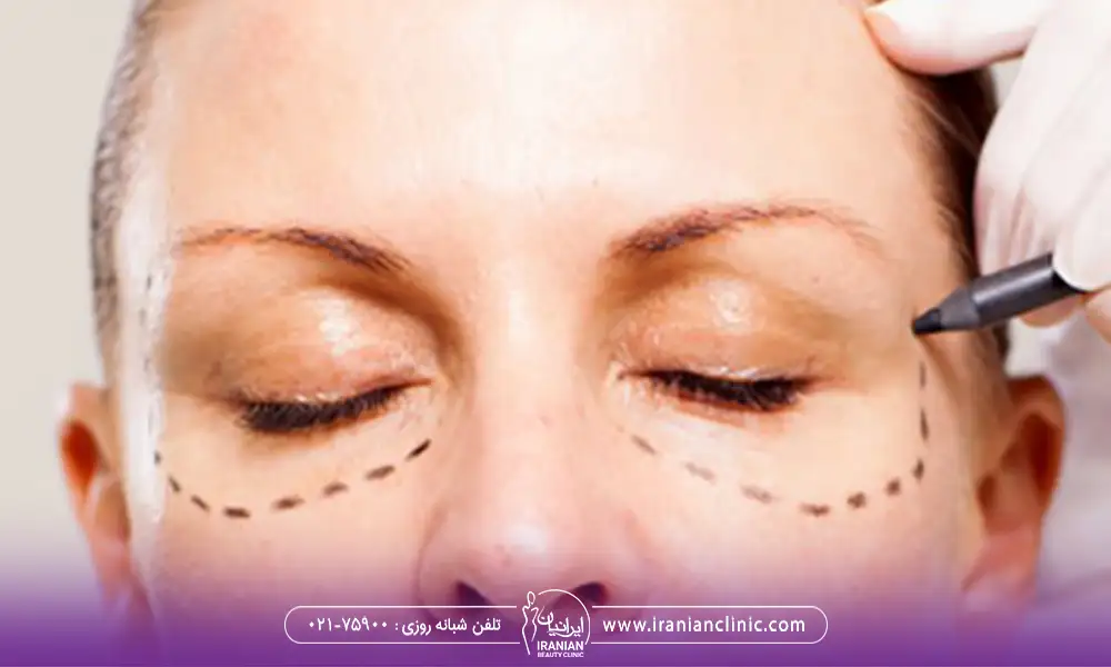 بهترین جراح پلک پایینی