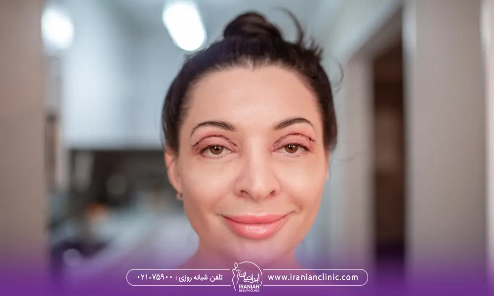 خانمی در حال اقدام برای کشیدن بخیه بلفاروپلاستی