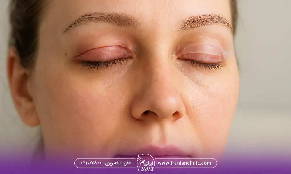 جای بخیه های عمل بلفاروپلاستی 