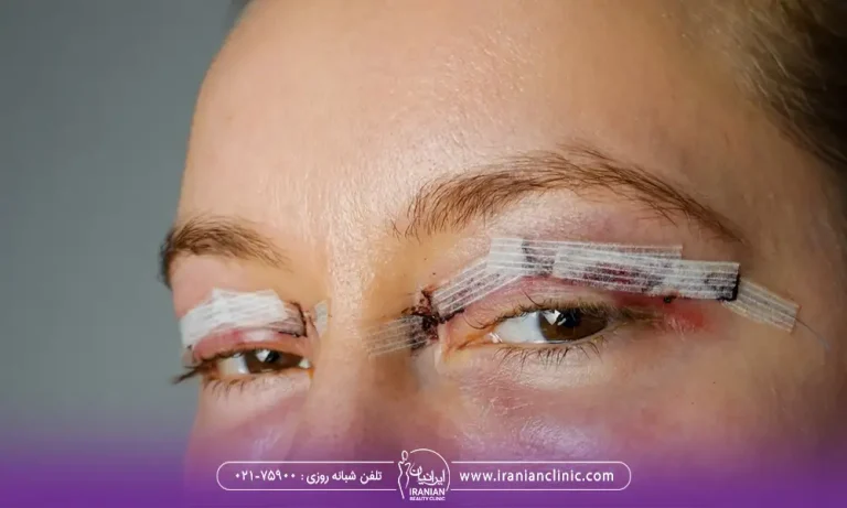 blepharoplasty-suture-removal