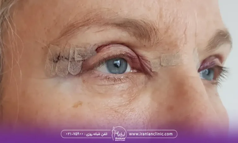 پانسمان بعد از جراحی پلک در دوره نقاهت بلفاروپلاستی