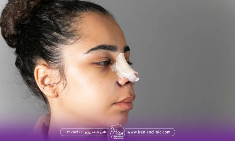 خانمی با افتادگی پلک بعد از عمل بینی