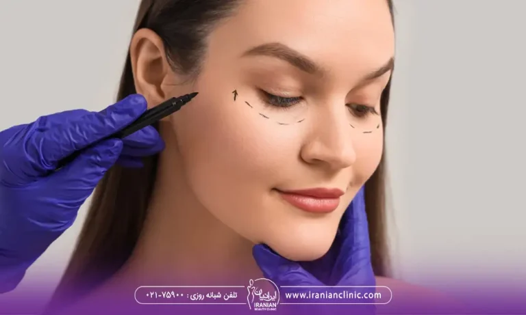 تعیین بلفاروپلاستی زیبایی و درمانی برای یک خانم