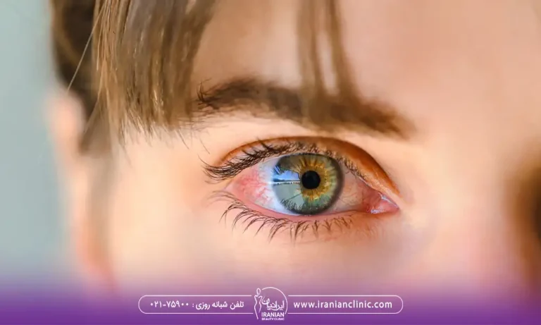خانمی با آبریزش چشم بعد از بلفاروپلاستی