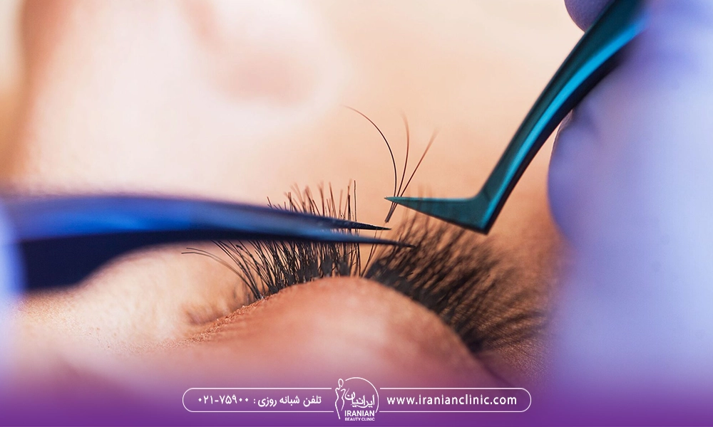 کاشت مژه بعد از بلفاروپلاستی به صورت دقیق