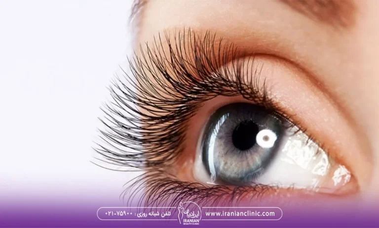عکس کاشت مژه بعد از بلفاروپلاستی برای زیبایی بیشتر چشم ها